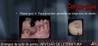 • Planos-guia  Face proximal, paralelos ao longo eixo do dente; 

