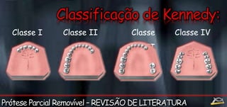 Classe I Classe II Classe 
III 
Classe IV 
 