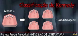 Classe I 
Modificações 
 