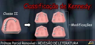 Classe II 
Modificações 
 