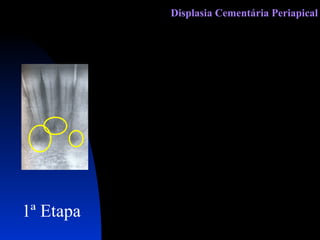 1ª Etapa Displasia Cementária Periapical 