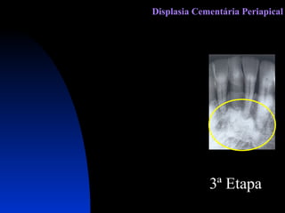 3ª Etapa Displasia Cementária Periapical 