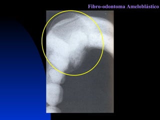 Fibro-odontoma Ameloblástico 