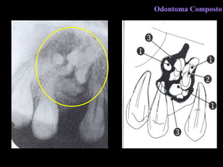 Odontoma Composto 