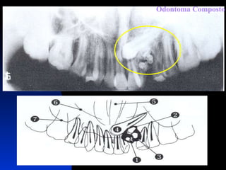 Odontoma Composto 