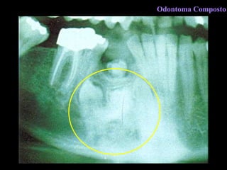 Odontoma Composto 