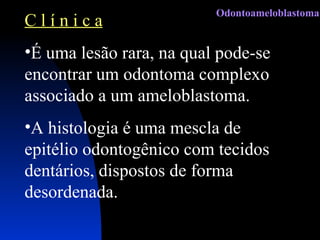 C l í n i c a É uma lesão rara, na qual pode-se encontrar um odontoma complexo associado a um ameloblastoma. A histologia é uma mescla de epitélio odontogênico com tecidos dentários, dispostos de forma desordenada. Odontoameloblastoma 