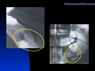 Odontoameloblastoma 