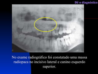 No exame radiográfico foi constatado uma massa radiopaca no incisivo lateral e canino esquerdo superior. . Dê o diagnóstico 