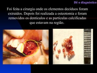 Foi feita a cirurgia onde os elementos decíduos foram extraídos. Depois foi realizada a osteotomia e foram removidos os dentículos e as partículas calcificadas que estavam na região.  Dê o diagnóstico 