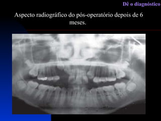 Aspecto radiográfico do pós-operatório depois de 6 meses.  Dê o diagnóstico 
