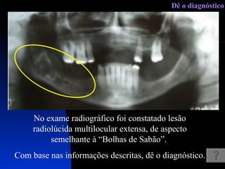 No exame radiográfico foi constatado lesão radiolúcida multilocular extensa, de aspecto semelhante à “Bolhas de Sabão”.  Com base nas informações descritas, dê o diagnóstico. Dê o diagnóstico 