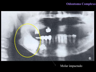 Molar impactado Odontoma Complexo 