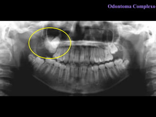 Odontoma Complexo 
