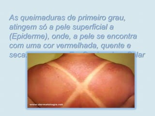 As queimaduras de primeiro grau,
atingem só a pele superficial a
(Epiderme), onde, a pele se encontra
com uma cor vermelhada, quente e
seca.            Ex: Queimadura Solar
 
