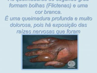 As queimaduras de segundo grau
  formam bolhas (Flictenas) e uma
              cor branca.
É uma queimadura profunda e muito
   dolorosa, pois há exposição das
      raízes nervosas que foram
               atingidas.
 