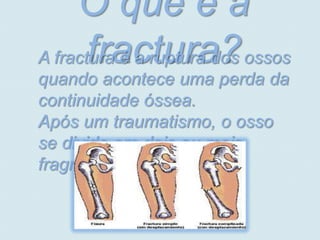 O que é a
       fractura?
A fractura é a ruptura dos ossos
quando acontece uma perda da
continuidade óssea.
Após um traumatismo, o osso
se divide em dois ou mais
fragmentos.
 