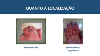 QUANTO À LOCALIZAÇÃO
Generalizada Localizada ou
Segmentar
 