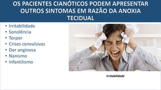 OS PACIENTES CIANÓTICOS PODEM APRESENTAR
OUTROS SINTOMAS EM RAZÃO DA ANOXIA
TECIDUAL
• Irritabilidade
• Sonolência
• Torpor
• Crises convulsivas
• Dor anginosa
• Nanismo
• Infantilismo
Irritabilidade
 