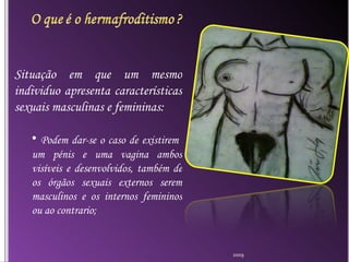 Situação em que um mesmo individuo apresenta características sexuais masculinas e femininas: Podem dar-se o caso de existirem  um pénis e uma vagina ambos visíveis e desenvolvidos, também de os órgãos sexuais externos serem masculinos e os internos femininos ou ao contrario; 2009 