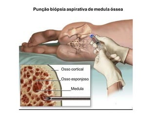 Punção biópsia aspirativa de medula óssea
Osso cortical
Osso esponjoso
Medula
 