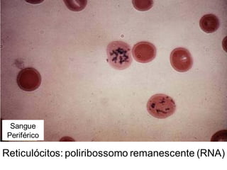 Reticulócitos: poliribossomo remanescente (RNA)
Sangue
Periférico
 