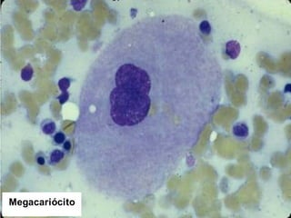 Medula Óssea, megacariócito
Megacariócito
 