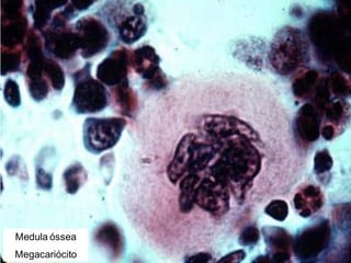 Medula óssea
Megacariócito
 