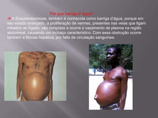                                        Por que barriga d’ água? A Esquistossomose, também é conhecida como barriga d’água, porque em seu estado avançado, a proliferação de vermes, presentes nas veias que ligam intestino ao fígado, são rompidas e ocorre o vazamento de plasma na região abdominal, causando um inchaço característico. Com essa obstrução ocorre também a fibrose hepática, por falta de circulação sanguínea.