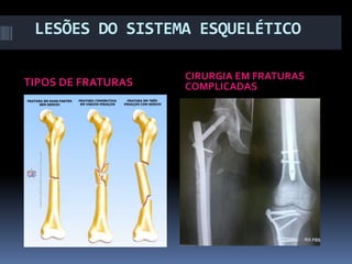 LESÕES DO SISTEMA ESQUELÉTICO
TIPOS DE FRATURAS

CIRURGIA EM FRATURAS
COMPLICADAS

 