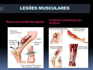 LESÕES MUSCULARES
Rutura do tendão de Aquiles

Tendinites (inflamação dos
tendões)

 