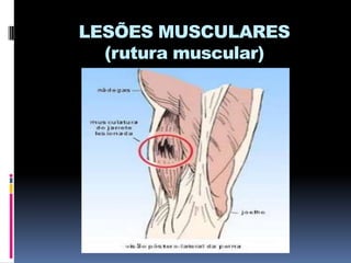 LESÕES MUSCULARES
(rutura muscular)

 
