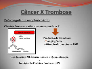 Câncer X Trombose
Pró-coagulante neoplásico (CP)
Cisteína Protease = ativa diretamente o fator X
Uso do Ácido All-transretinóico + Quimioterapia
=
Inibição da Cisteína Protease (CP)
Produção de trombina:
- Angiogênese
- Ativação de receptores PAR
Fase de iniciação
X
 