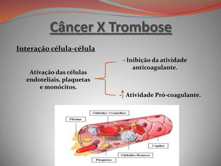 Câncer X Trombose
Interação célula-célula
Ativação das células
endoteliais, plaquetas
e monócitos.
- Inibição da atividade
anticoagulante.
- Atividade Pró-coagulante.
 