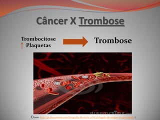Câncer X Trombose
Trombocitose
Plaquetas
Trombose
(Fonte: http://pt.dreamstime.com/fotografia-de-stock-co%C3%A1gulo-de-sangue-image22381492)
 