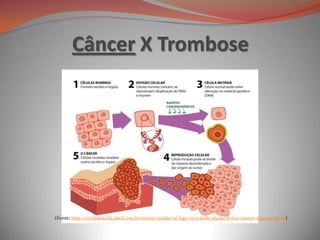 Câncer X Trombose
(Fonte: http://revistaescola.abril.com.br/ensino-medio/se-liga-voce-pode-ajudar-evitar-cancer-630044.shtml)
 