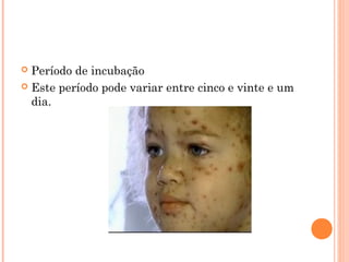 Período de incubação
 Este período pode variar entre cinco e vinte e um
dia.


 