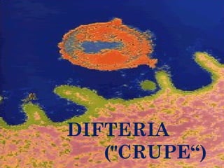 DIFTERIA
("CRUPE“)

 