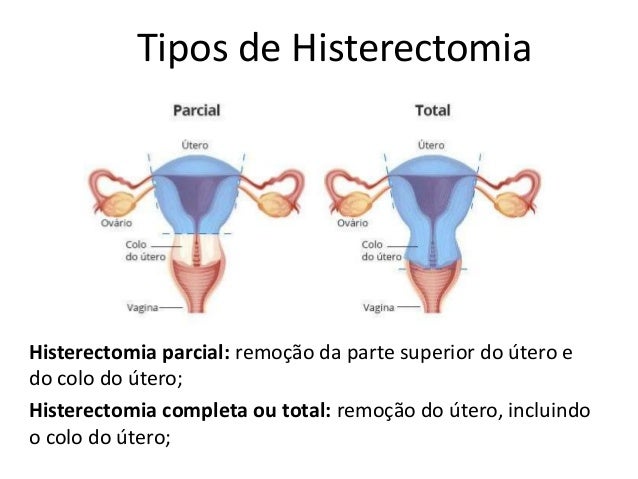 Trabalho histerectomia - saude da mulher