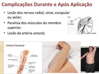 Complicações Durante e Após Aplicação
•
•
• Lesão dos nervos radial, ulnar, escapular
ou axilar;
Paralisia dos músculos do membro
superior;
Lesão da artéria umeral;
 