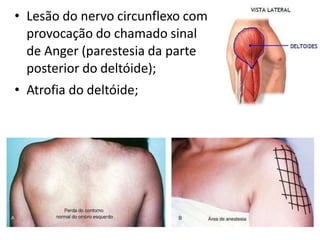 • Lesão do nervo circunflexo com
provocação do chamado sinal
de Anger (parestesia da parte
posterior do deltóide);
• Atrofia do deltóide;
 