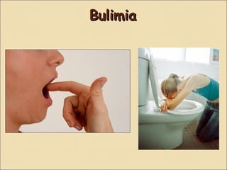 Bulimia
 