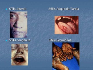 Sífilis latente                       Sífilis Adquirida TardiaSífilis congênita                   Sífilis Secundária