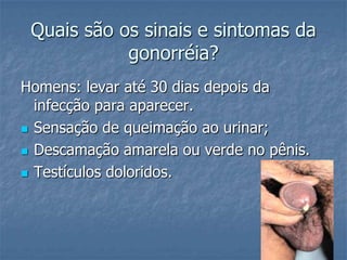 Quais são os sinais e sintomas da gonorréia?Homens: levar até 30 dias depois da infecção para aparecer.Sensação de queimação ao urinar;Descamação amarela ou verde no pênis.Testículos doloridos. 