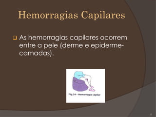Hemorragias Capilares
 As hemorragias capilares ocorrem
entre a pele (derme e epiderme-
camadas).
17
 