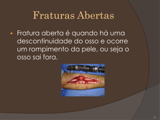 Fraturas Abertas
 Fratura aberta é quando há uma
descontinuidade do osso e ocorre
um rompimento da pele, ou seja o
osso sai fora.
27
 