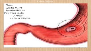 Úlceras Gástricas
Alunas:
Ana Rita 9ºC Nº3
Bruna David 9ºC Nº4
Prof.: Teresa Guedes
2º Período
Ano letivo: 2015/2016
 