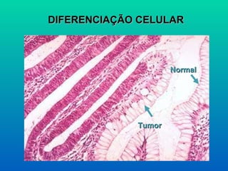 DIFERENCIAÇÃO CELULAR Tumor   Normal 