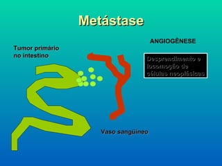 Metástase Tumor primário no intestino Vaso sangüíneo ANGIOGÊNESE Desprendimento e locomoção de células neoplásicas 