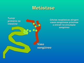 Tumor primário no intestino Metástase Células neoplásicas atingem vasos sangüíneos próximos e entram na circulação sangüínea Vaso sangüíneo 
